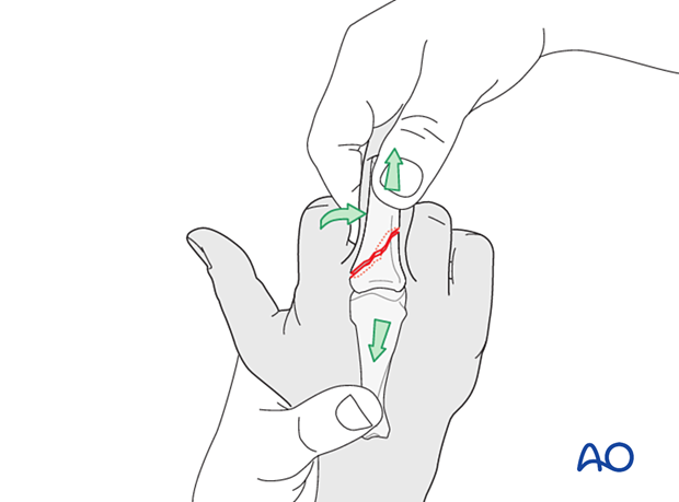 Traction and lateral pressure exerted at the site of maximal displacement to achieve reduction of a proximal phalangeal hand fracture.