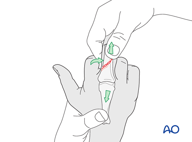 Traction and lateral pressure exerted at the site of maximal displacement to achieve reduction of an oblique diaphyseal phalangeal hand fracture