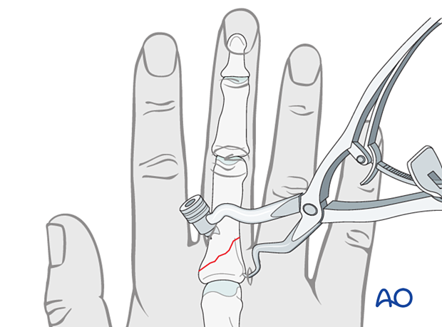 Reduction of an oblique proximal phalangeal hand fracture with reduction forceps.