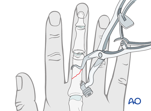 Reduction of an oblique diaphyseal phalangeal hand fracture with reduction forceps