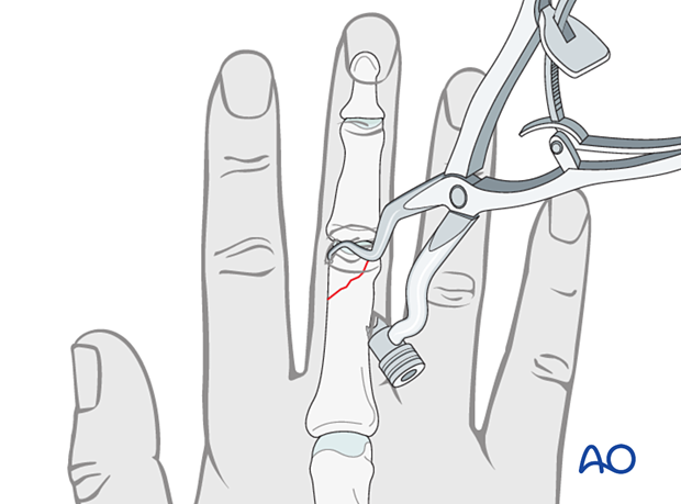 Reduction of an oblique distal phalangeal hand fracture with reduction forceps