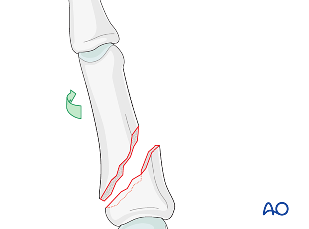 Rotation of finger for direct visualization of an oblique proximal phalangeal hand fracture