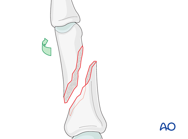 Rotation of finger proximal for direct visualization of an oblique diaphyseal phalangeal hand fracture