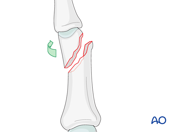 Rotation of finger proximal for direct visualization of an oblique distal phalangeal hand fracture