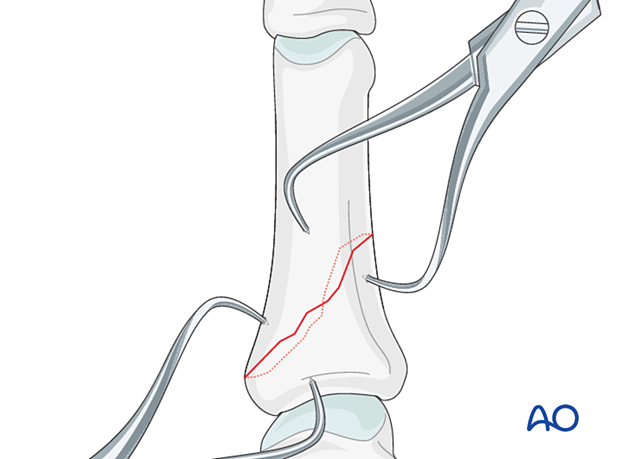 Application of pointed reduction forceps to reduce and hold an oblique proximal phalangeal hand fracture