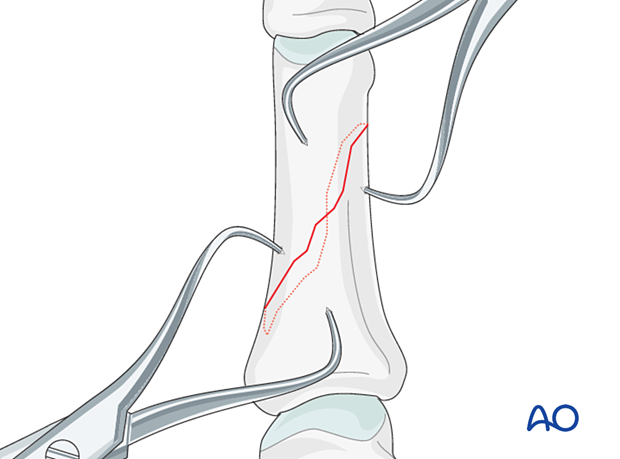 Application of a pointed reduction forceps to reduce and hold an oblique diaphyseal phalangeal hand fracture