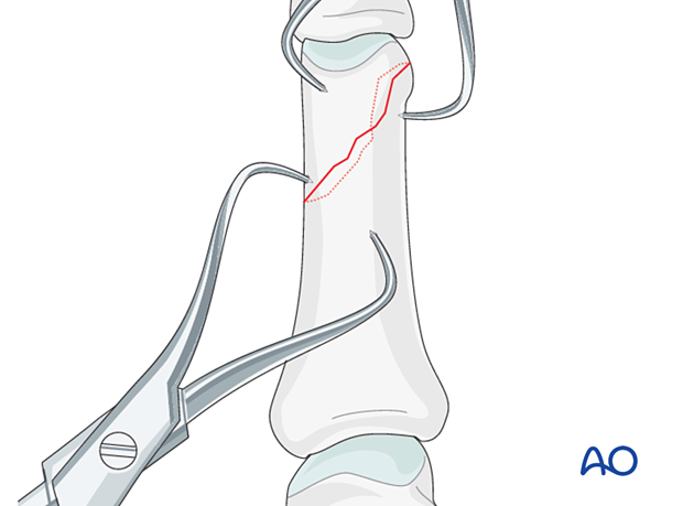 Application of pointed reduction forceps to reduce and hold an oblique distal phalangeal hand fracture