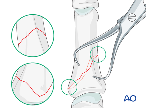 Visual confirmation of the reduction of by checking the apex of the fracture