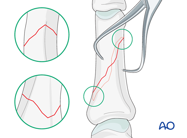 Visual confirmation of the reduction of by checking the apex of the fracture