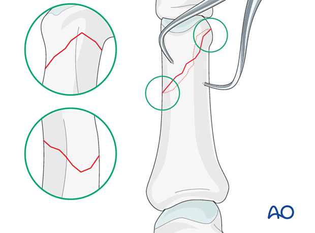 Visual confirmation of the reduction of by checking the apex of the fracture