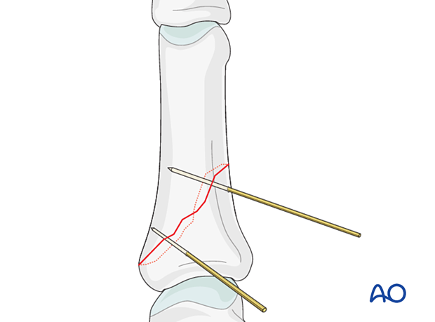 Two K-wires inserted to provisionally hold reduction of an oblique proximal phalangeal hand fracture