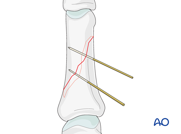 Two K-wires inserted to provisionally hold reduction of an oblique diaphyseal phalangeal hand fracture