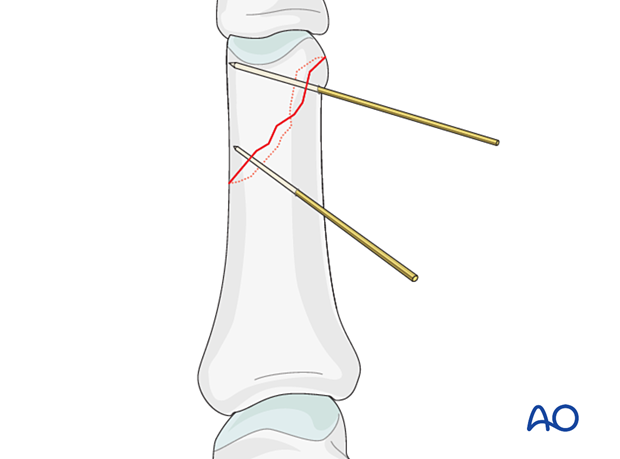 Two K-wires inserted to provisionally hold reduction of an oblique distal phalangeal hand fracture