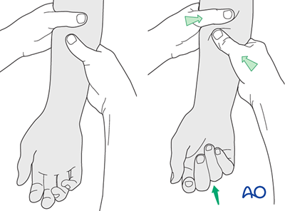 Plating with a dorsal T-plate for Complete articular fracture of the ...