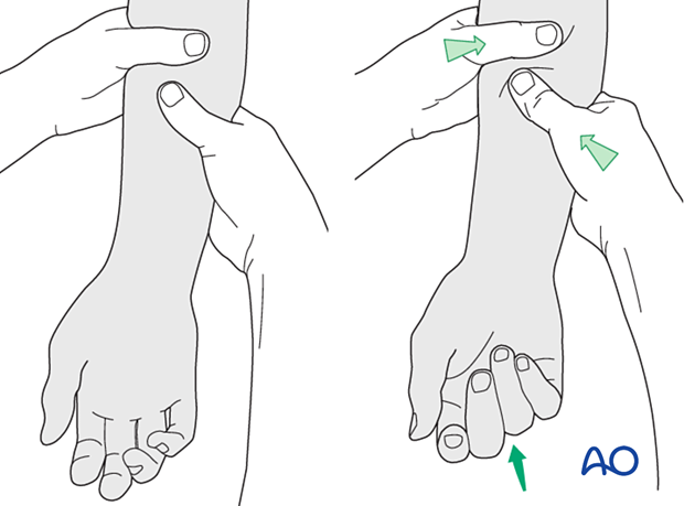 Surgeon exerting pressure against the muscle bellies of the proximal forearm to cause passive flexion of the fingers