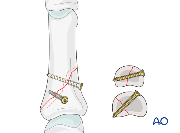 Lag screws inserted perpendicularly to the fracture plane for fixation of an oblique proximal phalangeal hand fracture