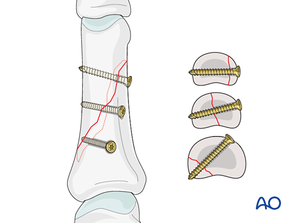 Lag screws inserted perpendicularly to the fracture plane for fixation of an oblique diaphyseal phalangeal hand fracture