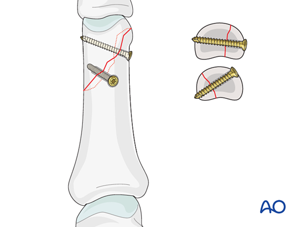 Lag screws inserted perpendicularly to the fracture plane for fixation of an oblique distal phalangeal hand fracture