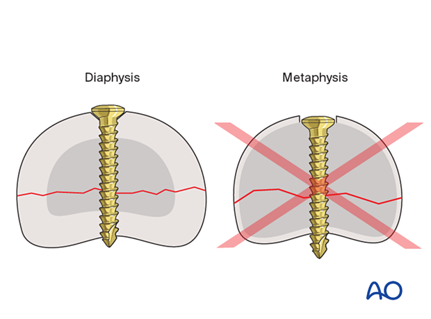 Countersinking can be performed in the diaphysis not the metaphysis