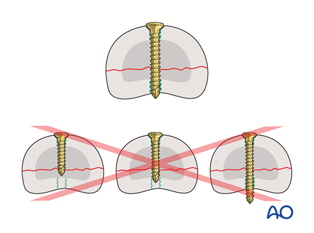 Correct screw length for fracture fixation means screws should not be too long or too short.