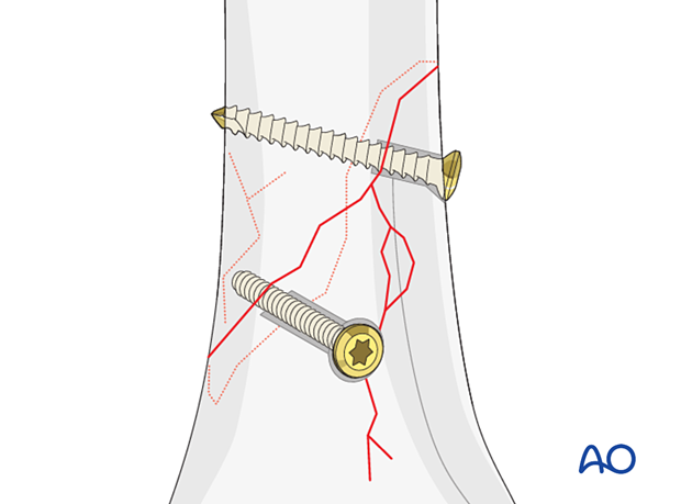 Screws inserted to avoid passing through short fissures