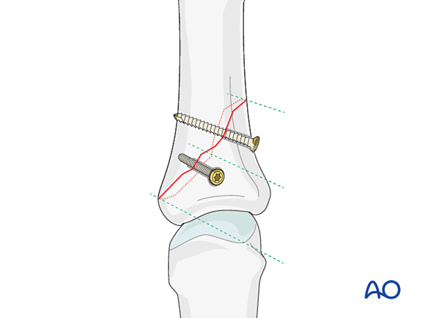 Fixation of an oblique proximal phalangeal hand fracture with two lag screws