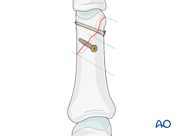 Fixation of an oblique distal phalangeal hand fracture with two lag screws