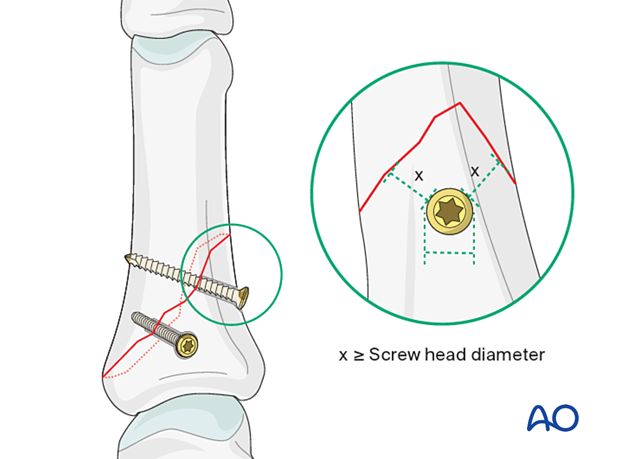 Peripheral screw insertion with minimal distance to the fracture line must be equal to the diameter of the screw head for an oblique proximal phalangeal hand fracture