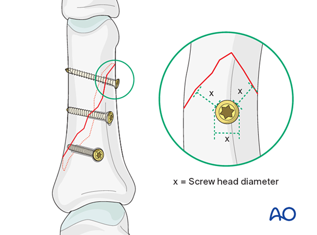 Peripheral screw insertion with minimal distance to the fracture line must be equal to the diameter of the screw head for an oblique diaphyseal phalangeal hand fracture