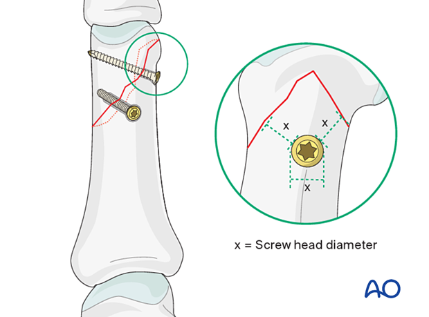 Peripheral screw insertion with minimal distance to the fracture line must be equal to the diameter of the screw head for an oblique distal phalangeal hand fracture