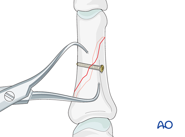 First lag screw inserted through center of the fracture surface in an oblique diaphyseal phalangeal hand fracture