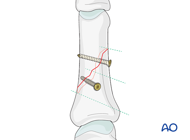 Two equally spaced lag screws inserted when fragment is too short for three lag screws in an oblique diaphyseal phalangeal hand fracture