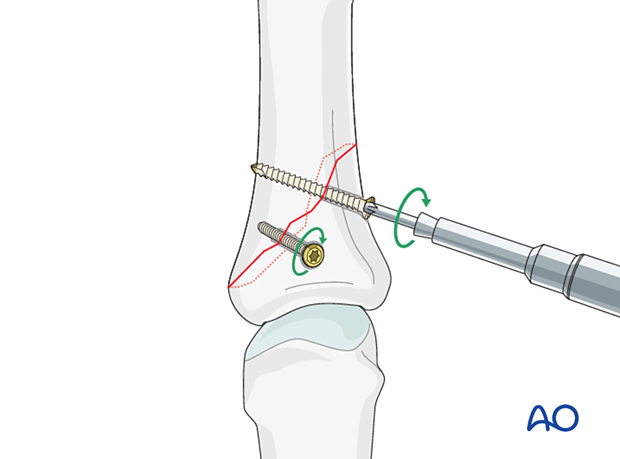 Two equally spaced lag screws inserted perpendicularly and tightened alternately in an oblique proximal phalangeal hand fracture