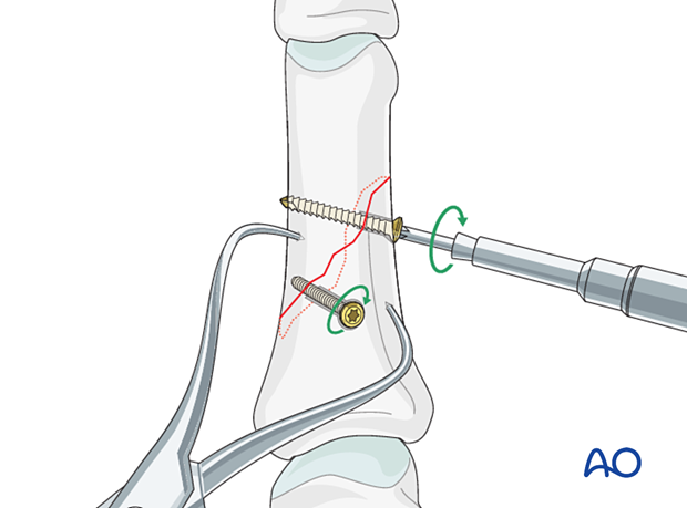 Two equally spaced lag screws inserted perpendicularly and tightened alternately in an oblique diaphyseal phalangeal hand fracture