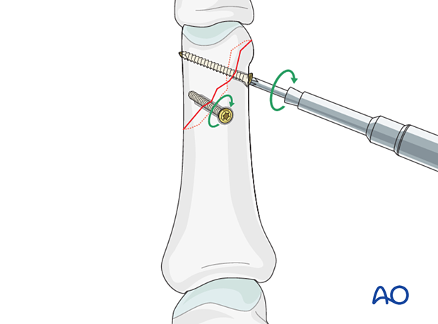 Two equally spaced lag screws inserted perpendicularly and tightened alternately in an oblique distal phalangeal hand fracture