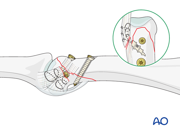 Reattachment of collateral ligament using an anchoring suture distal in an oblique phalangeal hand fracture