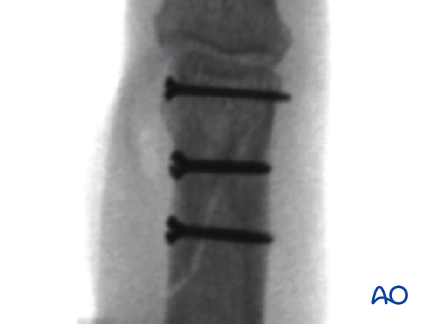 Image intensifier image confirms reduction and fixation of a proximal oblique phalangeal hand fracture 