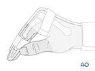 Dorsal splint on the hand and wrist