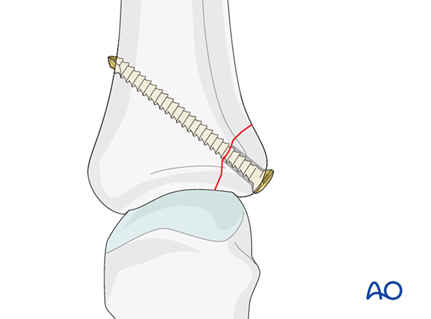 Screw fixation of an avulsion fracture of proximal phalanx metacarpophalangeal joint – hand