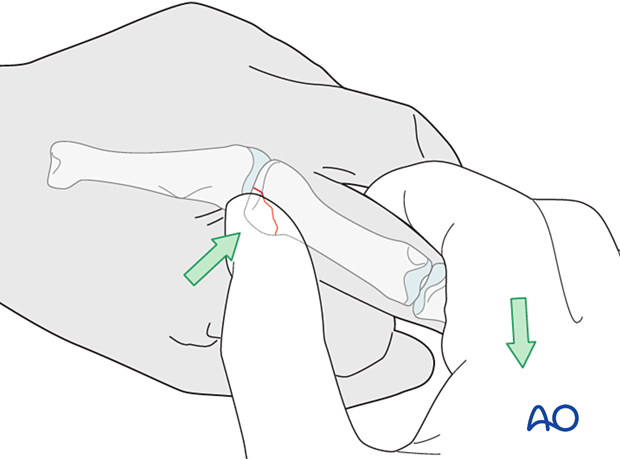 Indirect reduction of an avulsion fracture by surgeon pulling the finger into metacarpophalangeal joint flexion while surgeon’s thumb pushes the avulsed fragment into place 