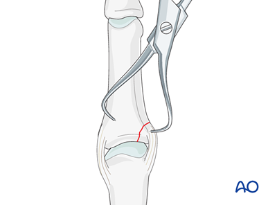 Lag-screw fixation for Avulsion at the proximal end segment