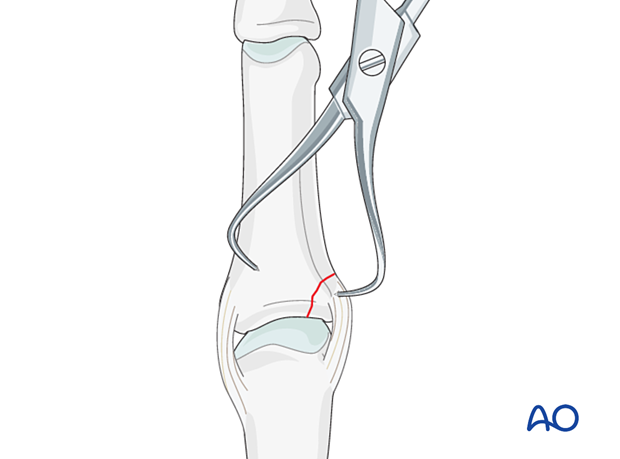 Application of pointed reduction forceps to reduce and hold an avulsion fracture of proximal phalanx - hand