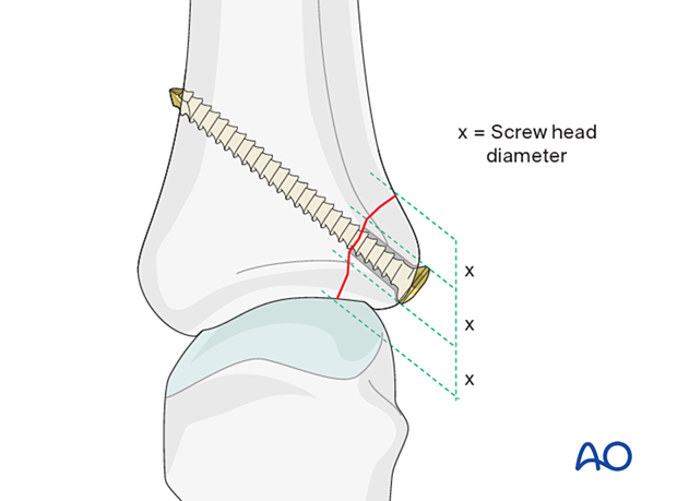 Maximal screw head diameter is one-third of the diameter of the avulsed fragment