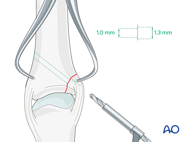 Determining the diameter of the gliding hole for lag screw insertion in an avulsion fracture of proximal phalanx metacarpophalangeal joint – hand