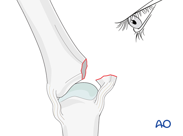 Visual evaluation of the fracture geometry with laterally deviated phalanx, to determine the gliding hole position for an avulsion fracture of proximal phalanx metacarpophalangeal joint – hand