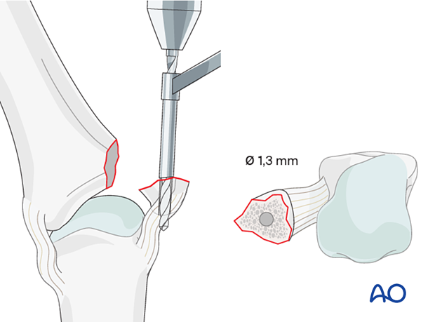 Drilling an inside-out gliding hole through the center of the avulsed fragment