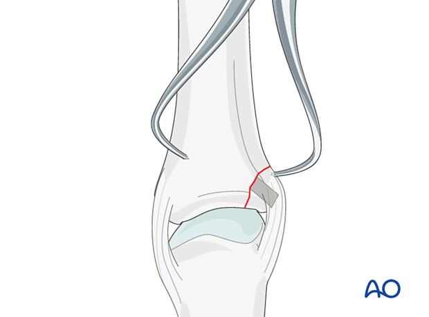 Application of pointed reduction forceps to reduce and hold an avulsion fracture of the proximal phalanx metacarpophalangeal joint – hand