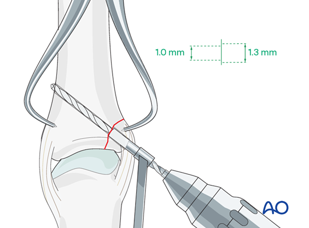 With the drill sleeve inserted into glide hole, the threaded hole is drilled into the opposite fragment, penetrating the far cortex  