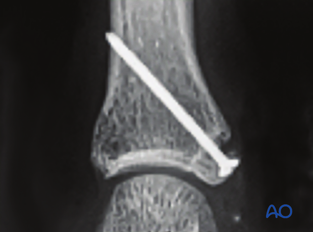 An AP x-ray confirms reduction of the avulsion fracture of the proximal phalanx metacarpophalangeal joint – hand