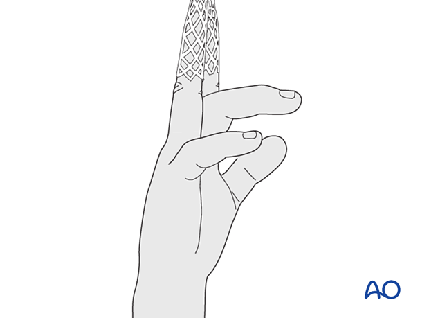 Index and ring finger in finger traps for ligamentotaxis